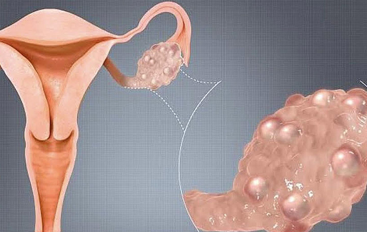 Estudo avalia alternativa para o tratamento de miomas uterinos